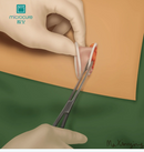 Disposable Incision Protection Sleeve