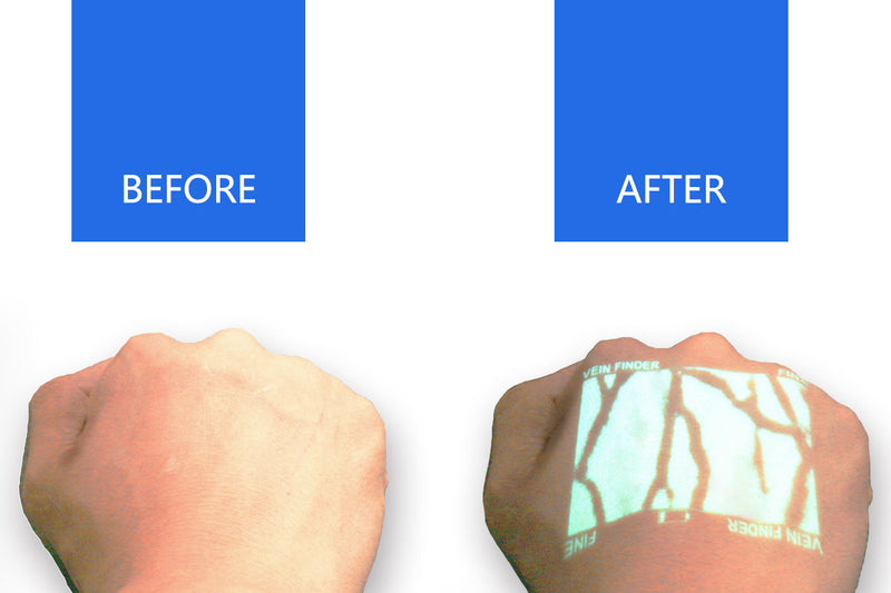 veinsight-veinfinder-hand-en